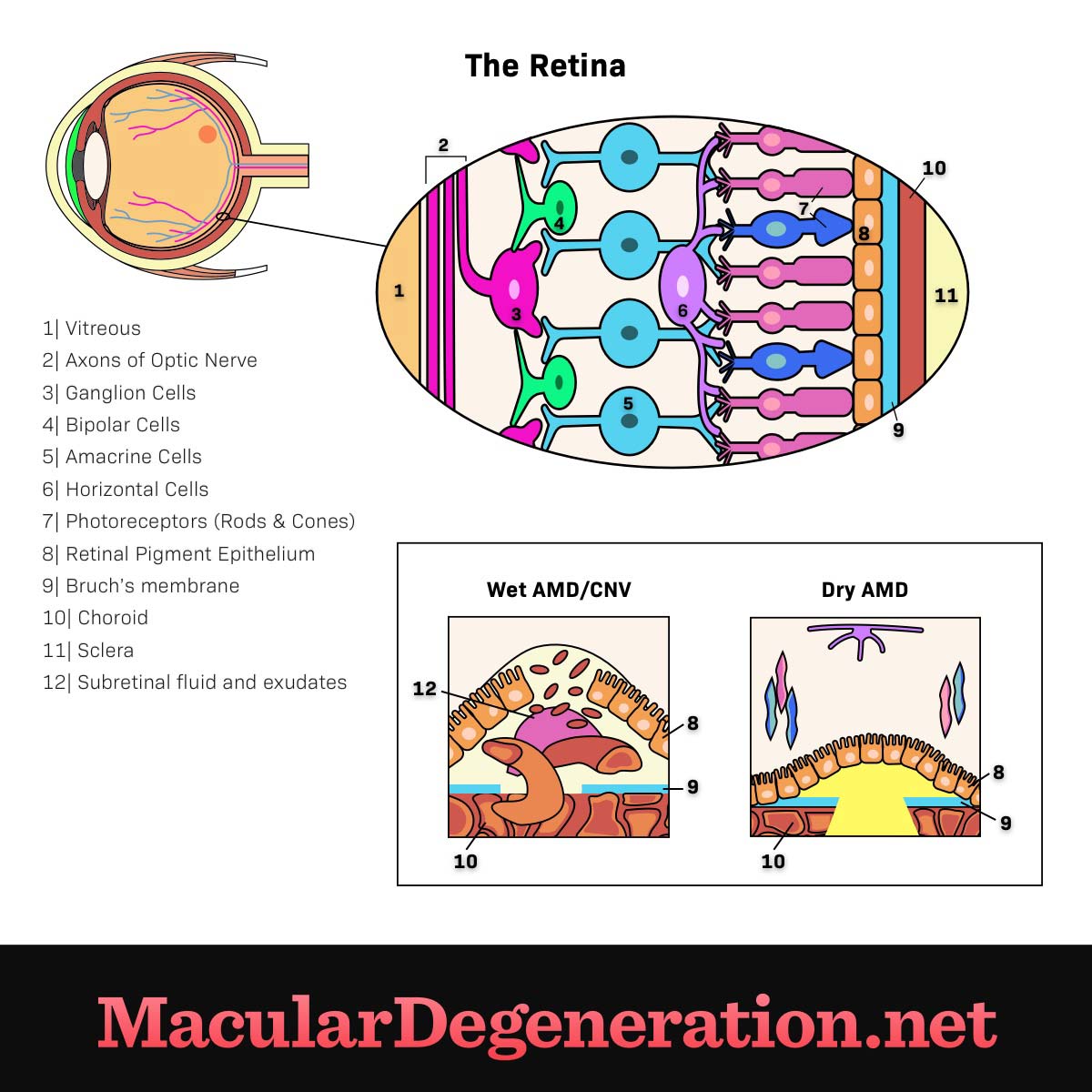 differences between wet and dry age related macular degeneration