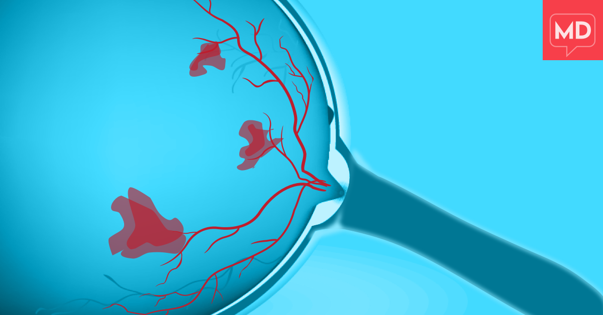 Macular Rvo What is Retinal Vein Occlusion? | MacularDegeneration.net
