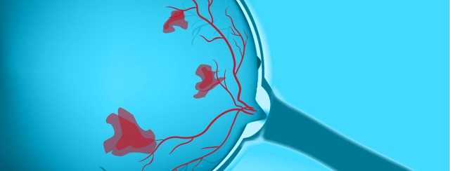 What is Retinal Vein Occlusion (RVO) and Macular Edema Following RVO (MEfRVO)? image