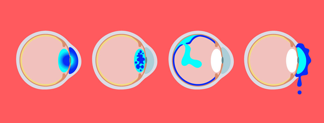 The inside profile view of 4 different eyeballs showing different types of side effects.