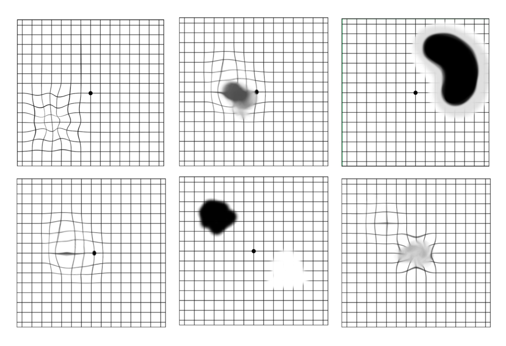 Amsler Grid Chart & Example