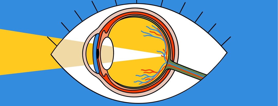 An anatomical drawing of an eye with light entering it is on top of a cartoon drawing of an eye.